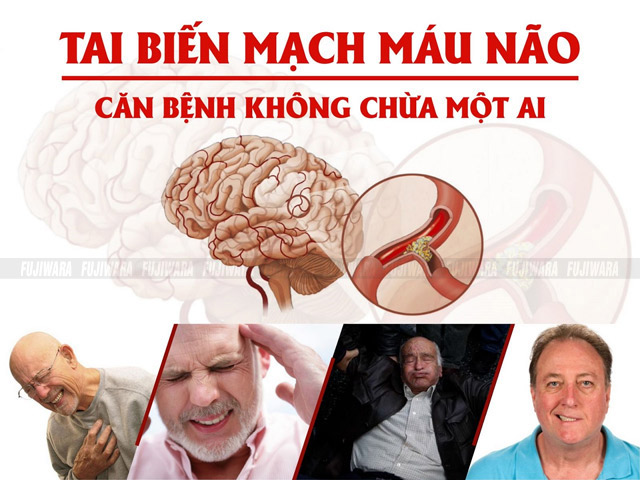 Tai biến mạch máu não căn bệnh nguy hiểm không chừa một ai