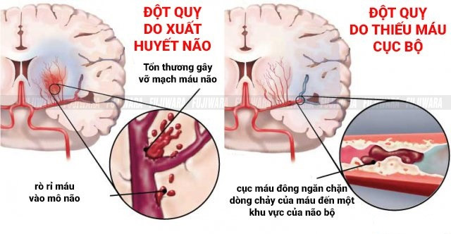 Nguyên nhân gây ra tai biến mạch máu não
