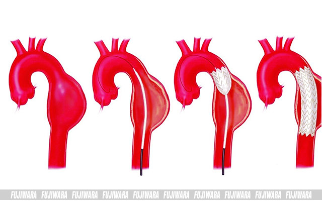 Phình động mạch