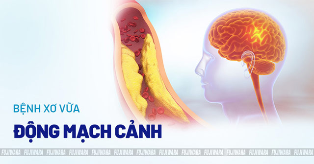 xơ vữa động mạch cảnh