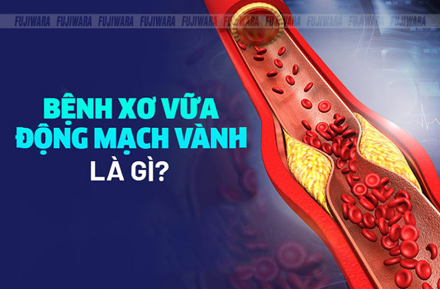 Xơ vữa động mạch là gì?